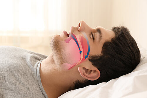 How To Know If You Have Sleep Apnea Nyc Sleepwell