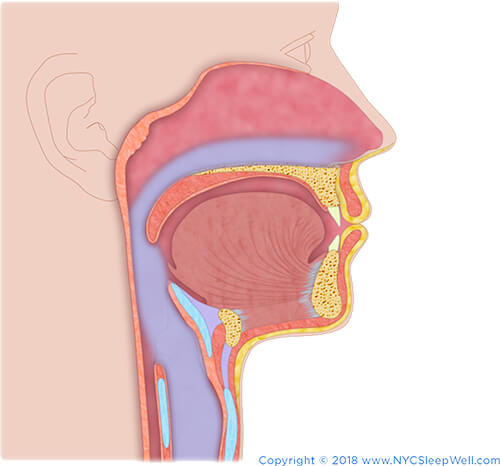 Frenectomy - Tongue Tie & Sleep Apnea | NYC Sleepwell